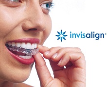 Элайнеры Invisalign